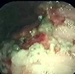 Gastric Ulceration Endoscopy Image courtesy AXON