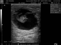 Early Preg Test Ultrasound image